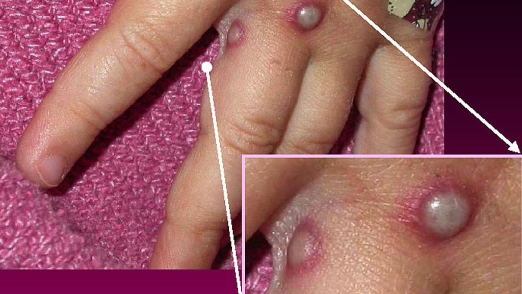 Variola, singura boală contagioasă de natură virală eliminată prin vaccinare